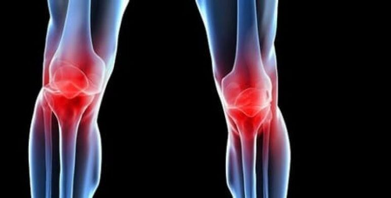 knee osteoarthritis