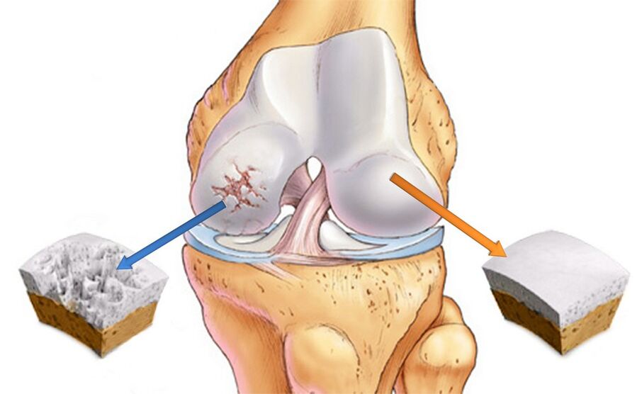 Artrosis of knee joint