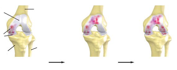 Rating of the Arthroose of knee joint