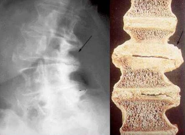 Vertebral damage in thoracic osteochondrosis