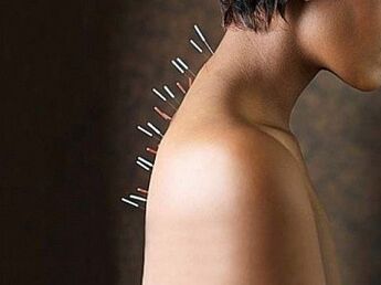 Reflexotherapy is an effective method in the treatment of cervical osteochondrosis